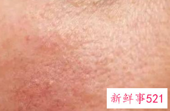 皮肤保护层受损表现