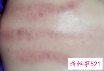 做完背部经络疏通疼好几天