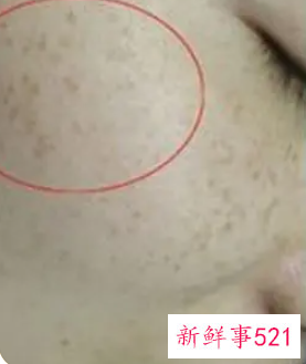 色斑淡化有效的方法