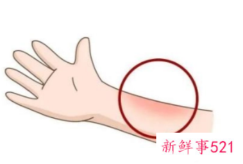 皮肤烫伤了在家里怎么处理