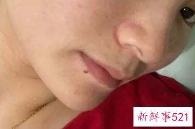 用过期护肤品脸红肿怎么办