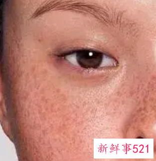 色斑淡化有效的方法