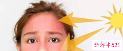 夏季晒伤后如何快速恢复美白