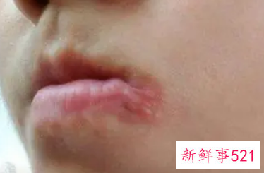 嘴角起泡要不要弄破