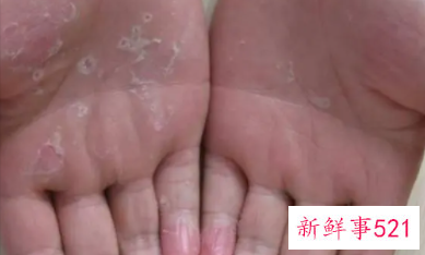 手心皮很硬很粗糙怎么回事