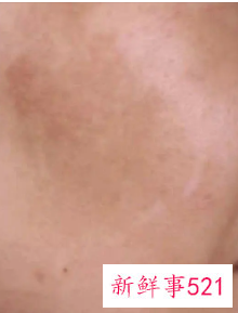 蝴蝶斑如何去除