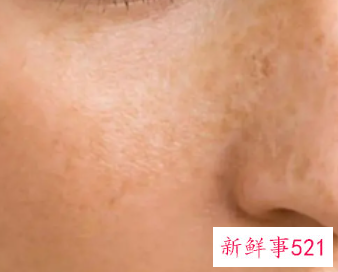 色斑淡化有效的方法