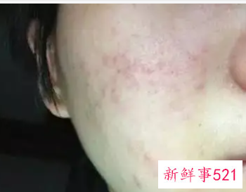 冬天脸上长小痘痘还干皮痒
