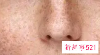 脸上很多雀斑该怎么办