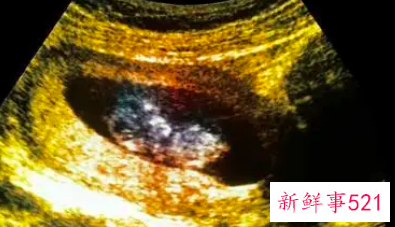 怀孕9个多月胎死腹中的征兆