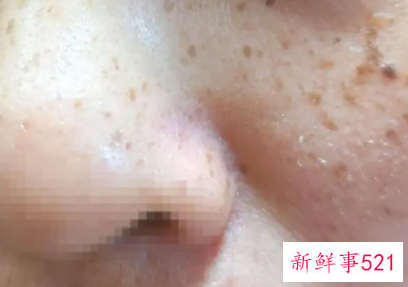 怎么辨别脸上是什么斑