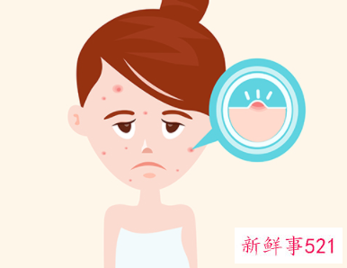 青春期脸上长痘痘怎么调理和偏方