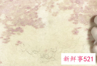 特发性色素减退斑可以治好吗