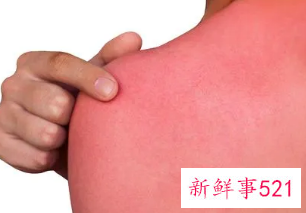 日光性皮炎奇痒难耐