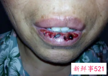 孩子烂嘴怎么办