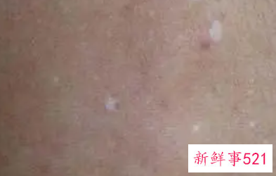 特发性色素减退斑可以治好吗