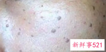 脸上有斑和黑色素该怎么消除