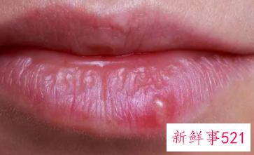 嘴角起泡是什么原因及治疗方法