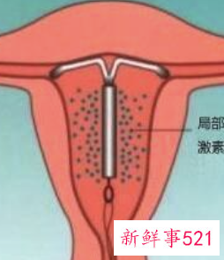 带环受孕怎么回事