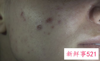 将痘痘扼杀于萌芽中不是困难