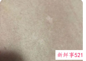 特发性色素减退斑可以治好吗