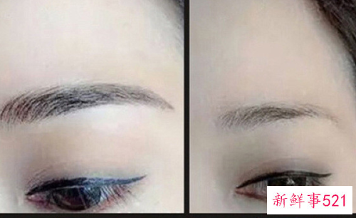 激光洗眉注意事项