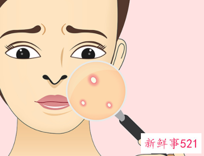 青春期脸上长痘痘怎么调理和偏方