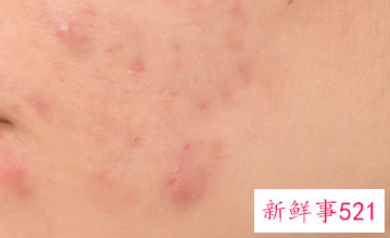 将痘痘扼杀于萌芽中不是困难