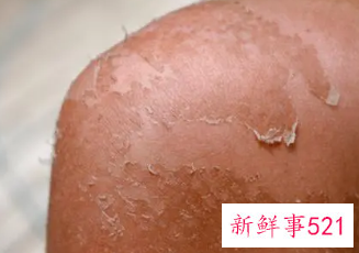 日光性皮炎奇痒难耐