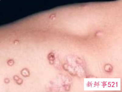 hpv是什么病怎么得的会传染吗