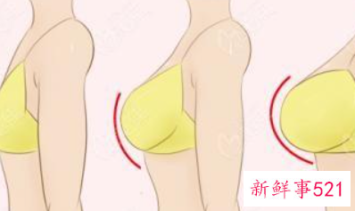 自体脂肪丰胸三四年后