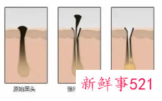 哪些偏方可以去除黑头