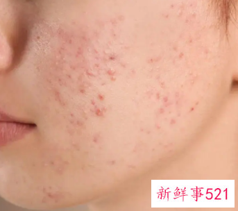 补水真的可以淡化色斑