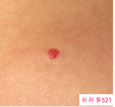 胳膊上有小红点怎么办