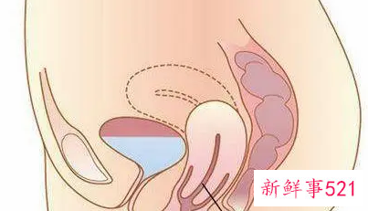 子宫下垂有什么症状