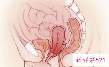 子宫下垂有什么症状