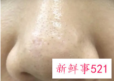 哪些偏方可以去除黑头