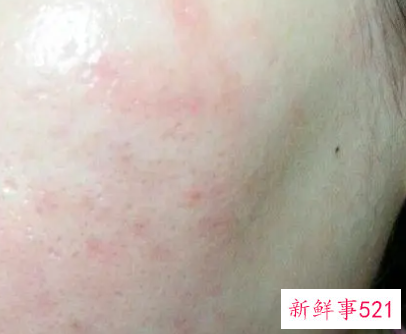 春天皮肤瘙痒的原因