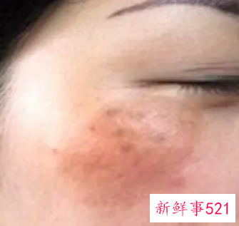 脸上有斑和黑色素该怎么消除
