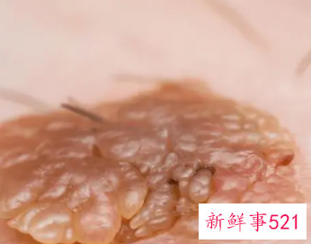 hpv是什么病怎么得的会传染吗