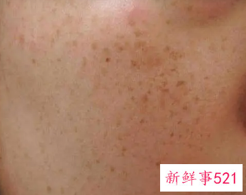 补水真的可以淡化色斑