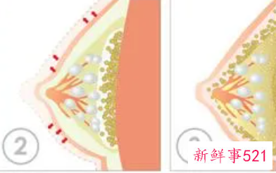 自体脂肪丰胸三四年后