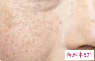 脸上有斑和黑色素该怎么消除