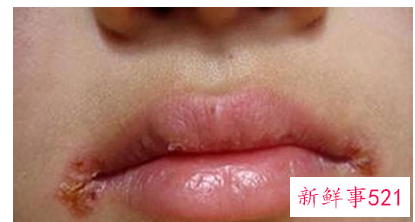 孩子烂嘴怎么办