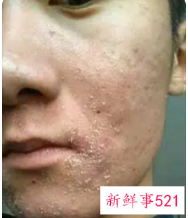 脸上脱皮发红发痒紧绷