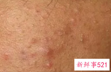 哪种痘痘是内分泌失调吃什么维生素