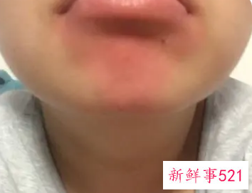 下巴发红不痛不痒怎么回事