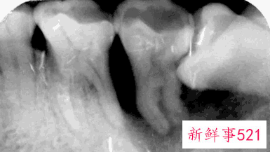 怎么看自己有没有智齿