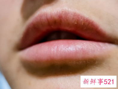 病人嘴唇干用什么
