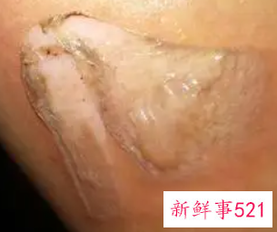 烫伤皮掉了肉红红的会留疤吗